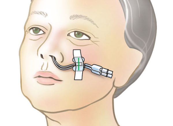 step5 | Rapid Rhino Epistaxis Device